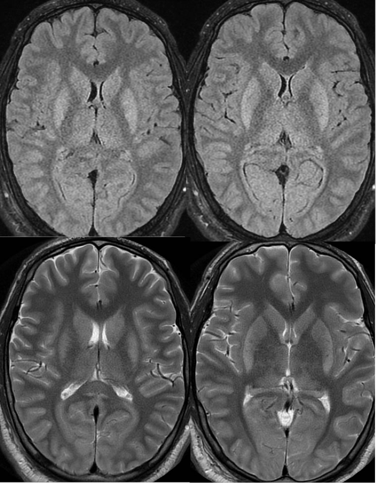 anoxic-brain-injury